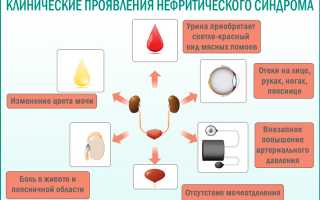 Гломерулонефрит нефротический синдром дифференциальная диагностика
