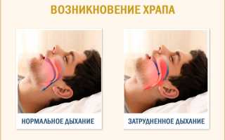 Тяжелый синдром обструктивного апноэ сна