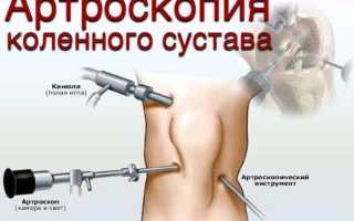 Код мкб мениск коленного сустава