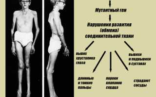 Передача по наследству синдрома марфана