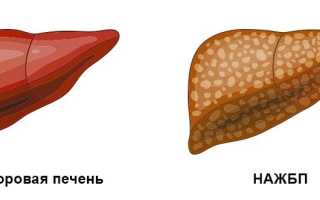 Неалкогольная болезнь печени и метаболический синдром