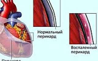 Кардиотомный синдром что это такое