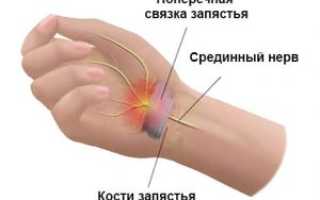 Туннельный синдром запястья лечение при беременности