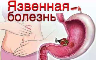 Цирроз печени симптомы код мкб