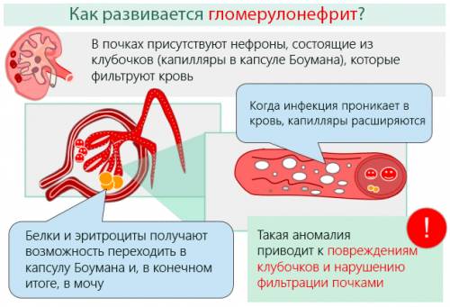 Хронический гломерулонефрит с нефротическим синдромом прогноз