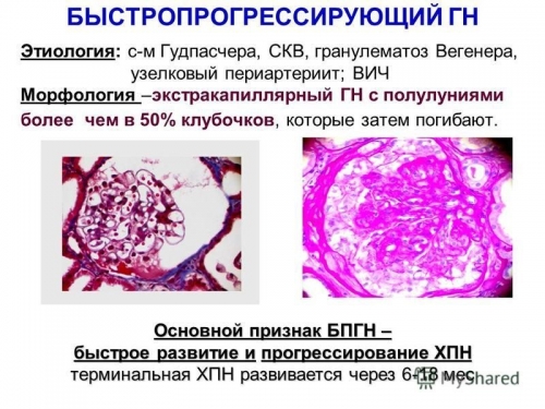 Хронический гломерулонефрит с нефротическим синдромом прогноз