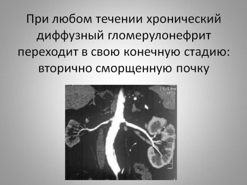 Хронический гломерулонефрит с нефротическим синдромом прогноз