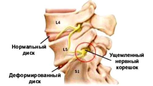 Лечение корешкового синдрома шейного отдела народными средствами