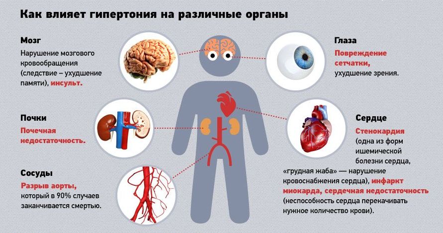 Коды мкб 10 синдром позвоночной артерии