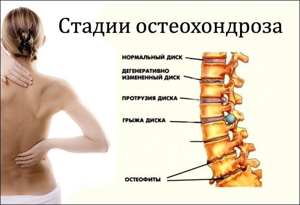 Стадии остеохондроза