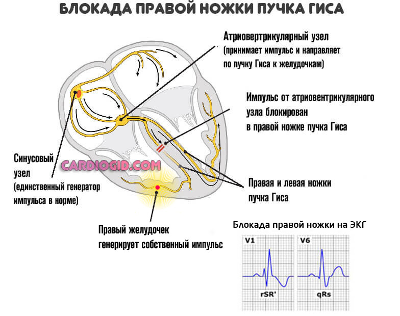 blokada-pravoj-nozhki-puchka-gisa