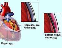 Постперикардиотомный синдром