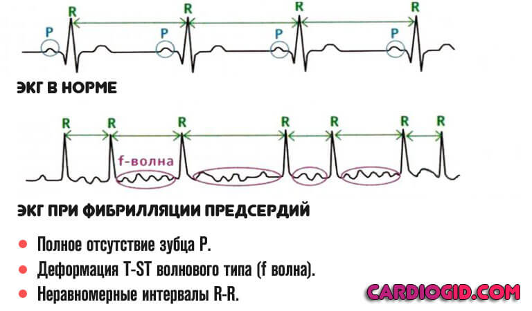 фибрилляция предсердий на экг