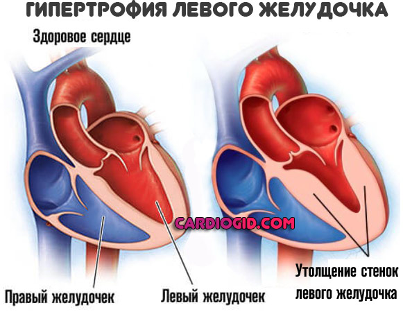 гипертрофия-левого-желудочка