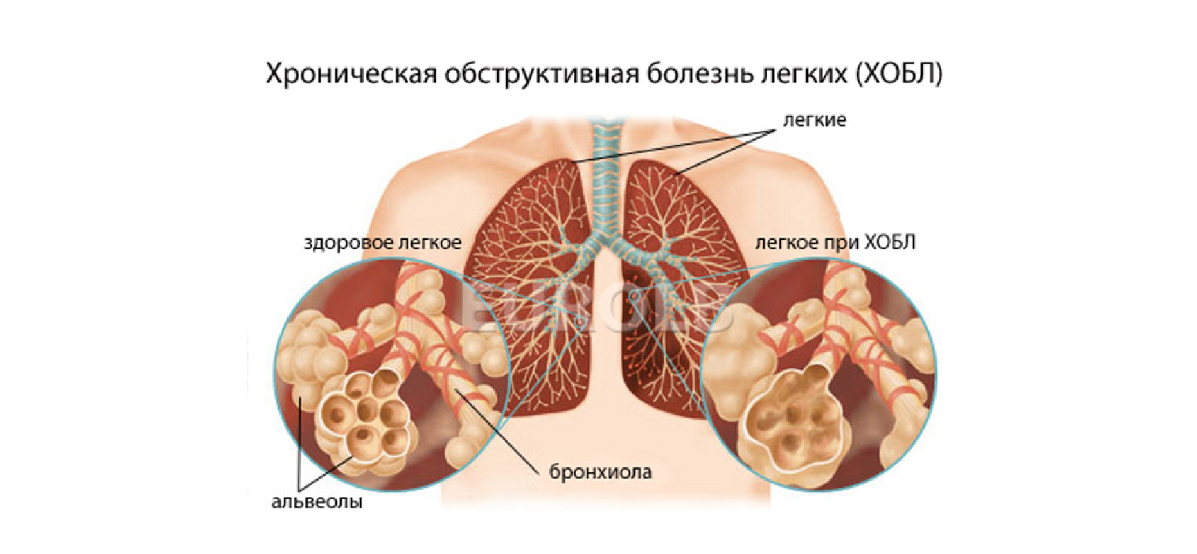Основные синдромы при заболевании легких