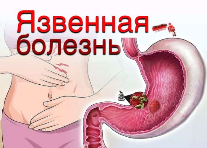 Язвенная болезнь: причины, симптомы, диагностика, лечение