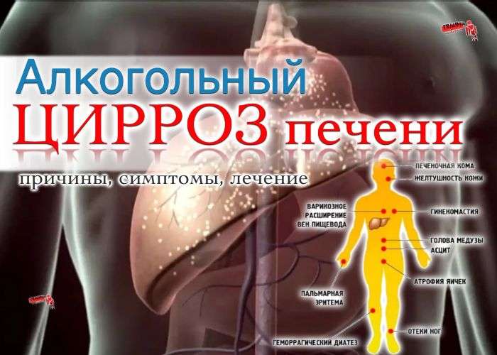 Алкогольный цирроз печени - причины, симптомы, диагностика, лечение