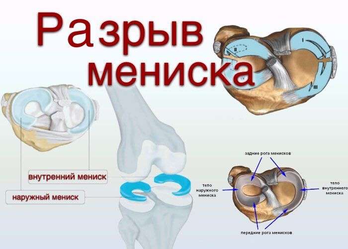 разрыв мениска