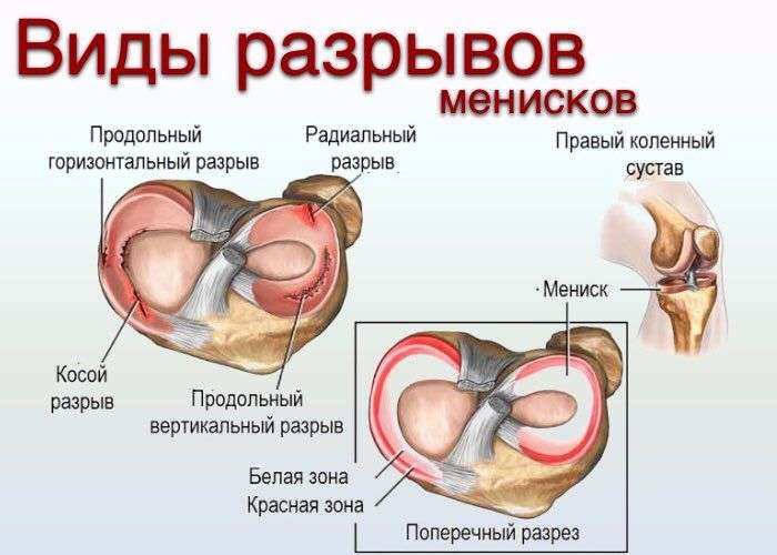 разрыв мениска