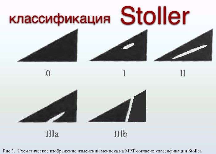 разрыв мениска
