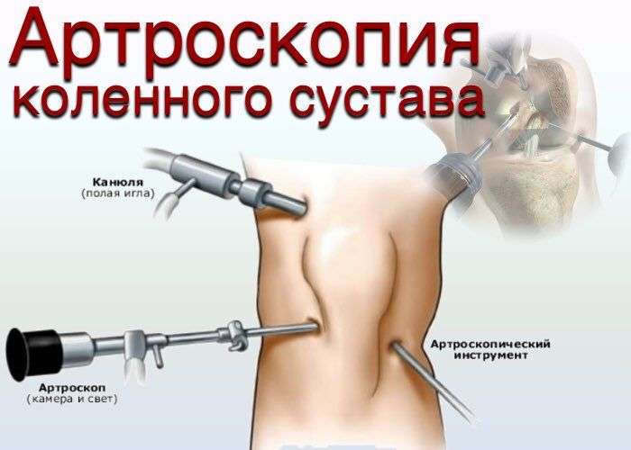 разрыв мениска