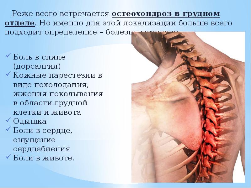 Лечение корешкового синдрома шейного отдела народными средствами