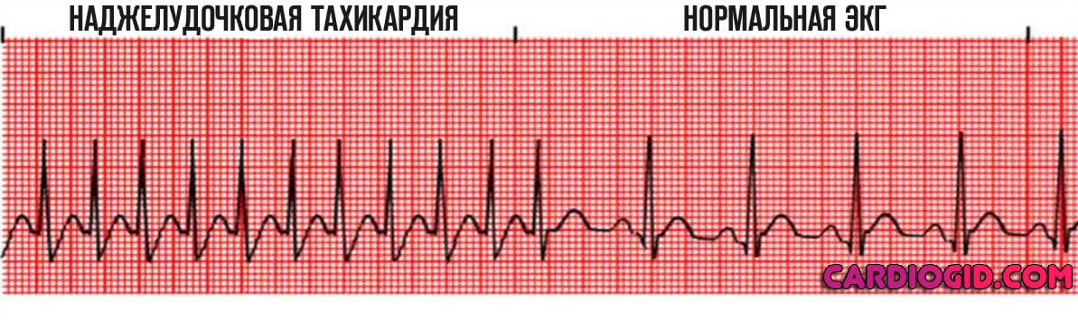 наджелудочковая тахикардия на экг