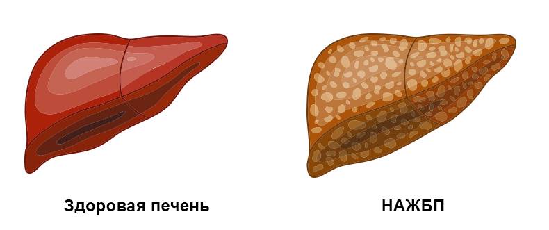 Неалкогольная жировая болезнь печени