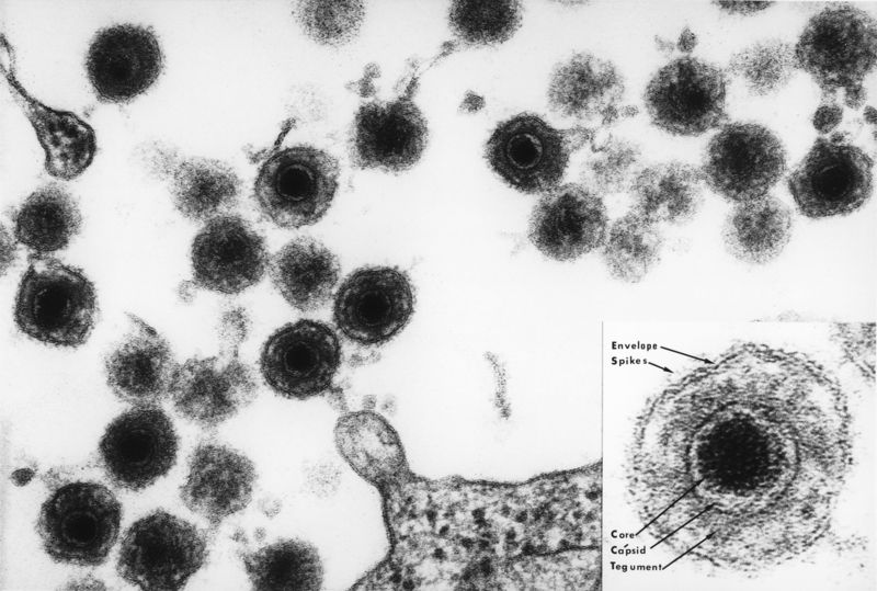 Varicella Zoster, вызывающий опоясывающий лишай