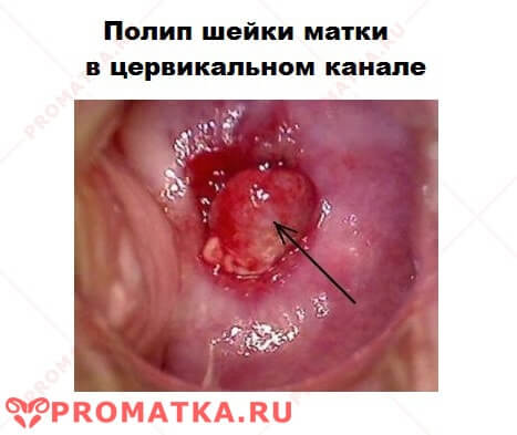 Цервикальный полип