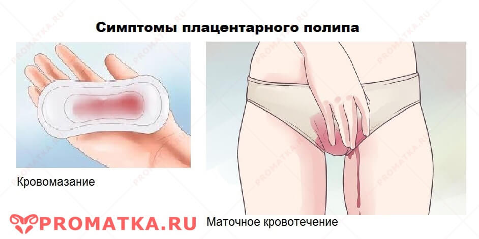 Симптомы плацентарного полипа