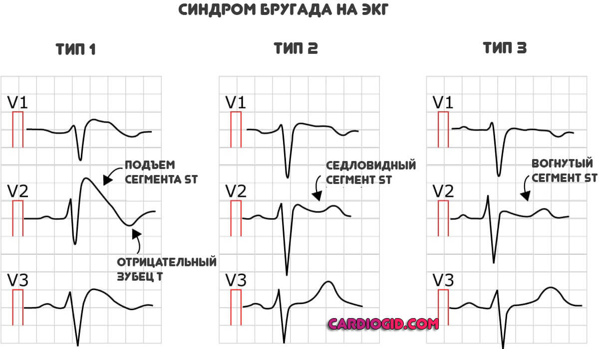 синдром-бругада-на-экг