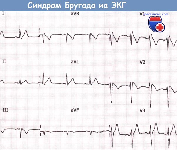 Синдром Бругада на ЭКГ