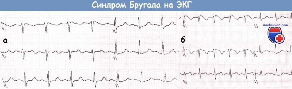Синдром Бругада на ЭКГ
