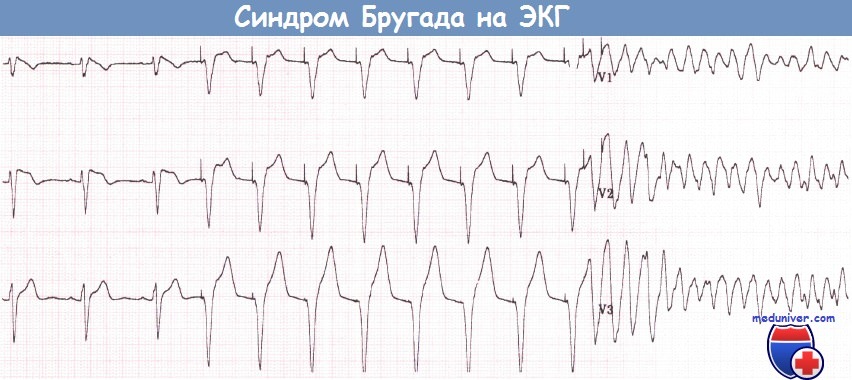 Синдром Бругада на ЭКГ