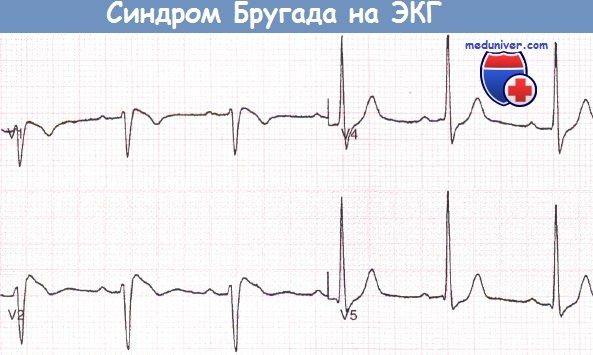 Синдром Бругада на ЭКГ