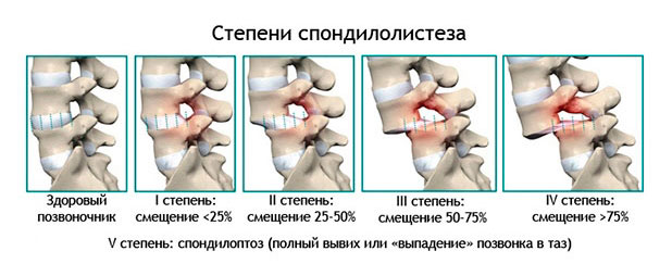 Боль при смещении межпозвоночного диска