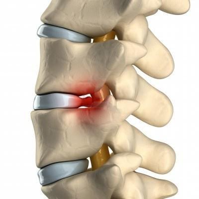 Болит спина в области поясницы и отдает в пах чем лечить