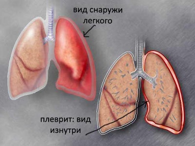 Почему не чем дышать болит за ребрами и спина