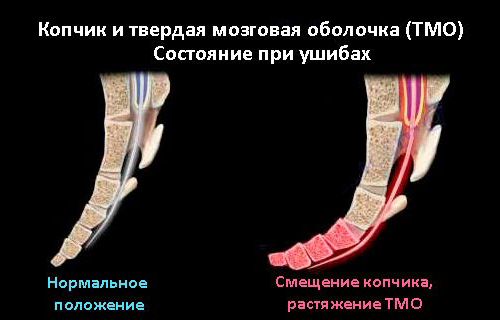 Болит спина и копчик у ребенка