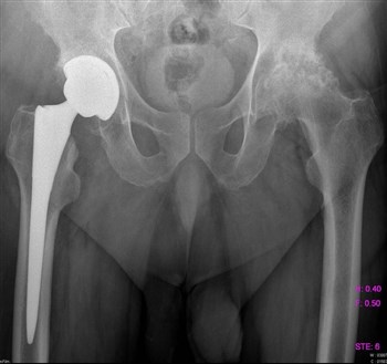 Болит спина в области поясницы и отдает в пах чем лечить