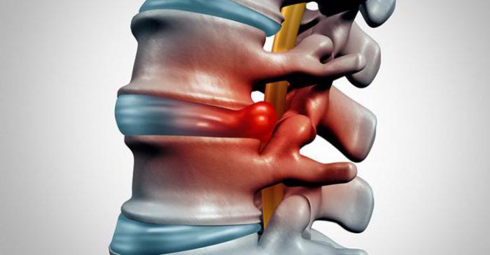 утром когда встаю сильно болит спина