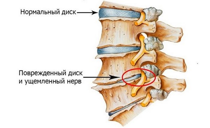Самая частая причина таких болей – остеохондроз (чаще поясничного отдела, но может быть и грудного отдела позвоночника) при вдохе болят почки