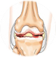 Симптомы и причины возникновения артроза
