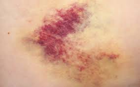 После физической нагрузки болит спина под лопатками