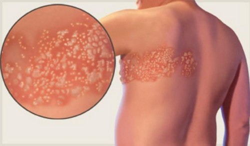 Почему болит спина между лопаток после сна