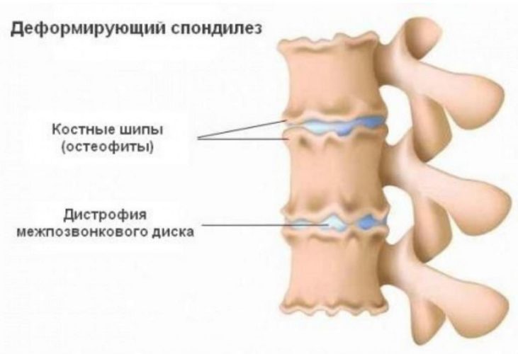 Деформирующий спондилез