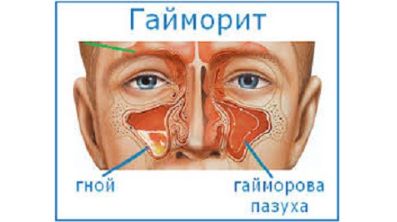 Из за чего может болеть спина и температура