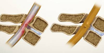 Болит спина в области поясницы и отдает в пах чем лечить