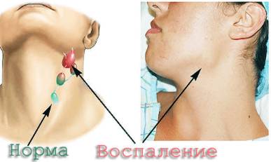Из за чего может болеть спина и температура